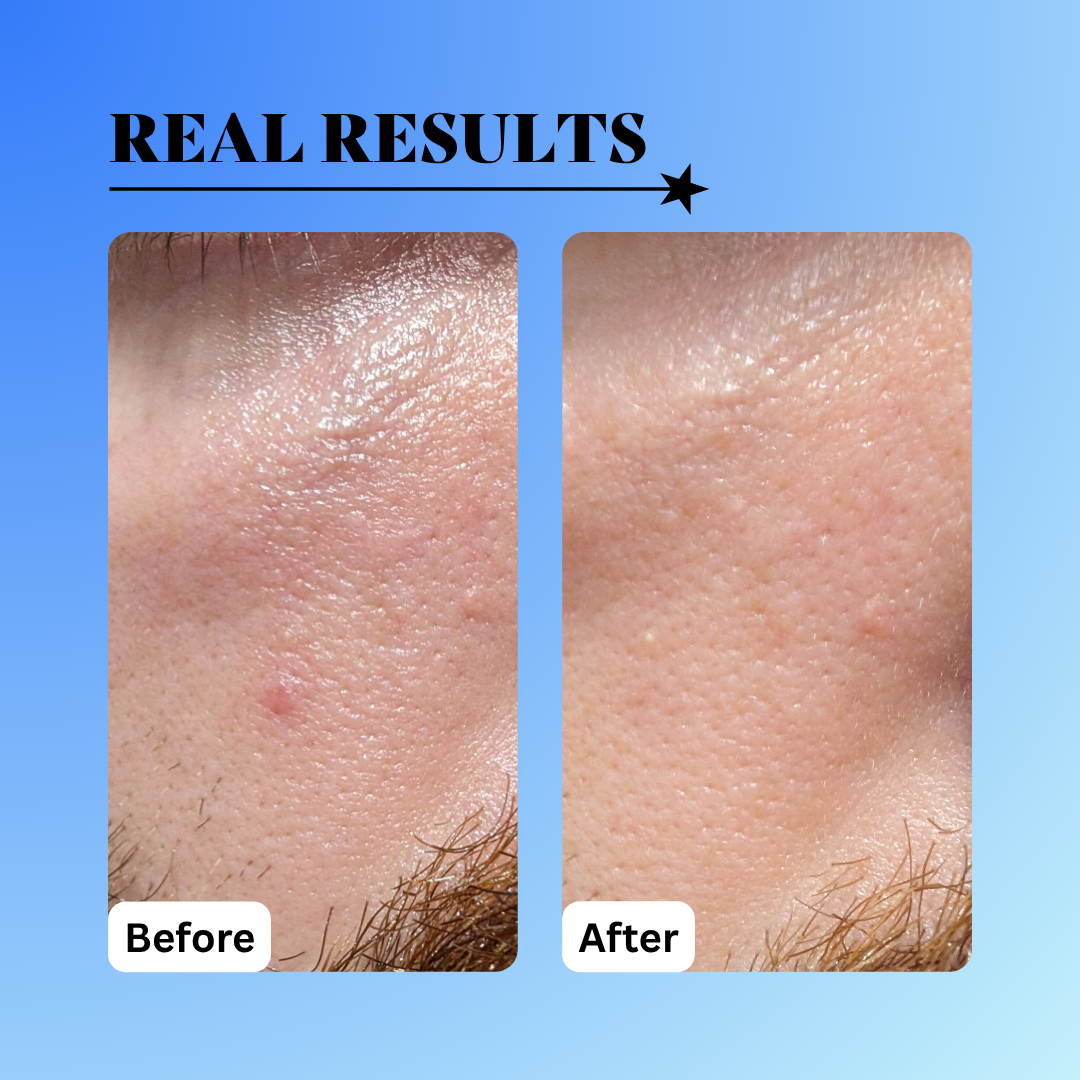 before and after rough texture using the 10% glycolic treatment tonic