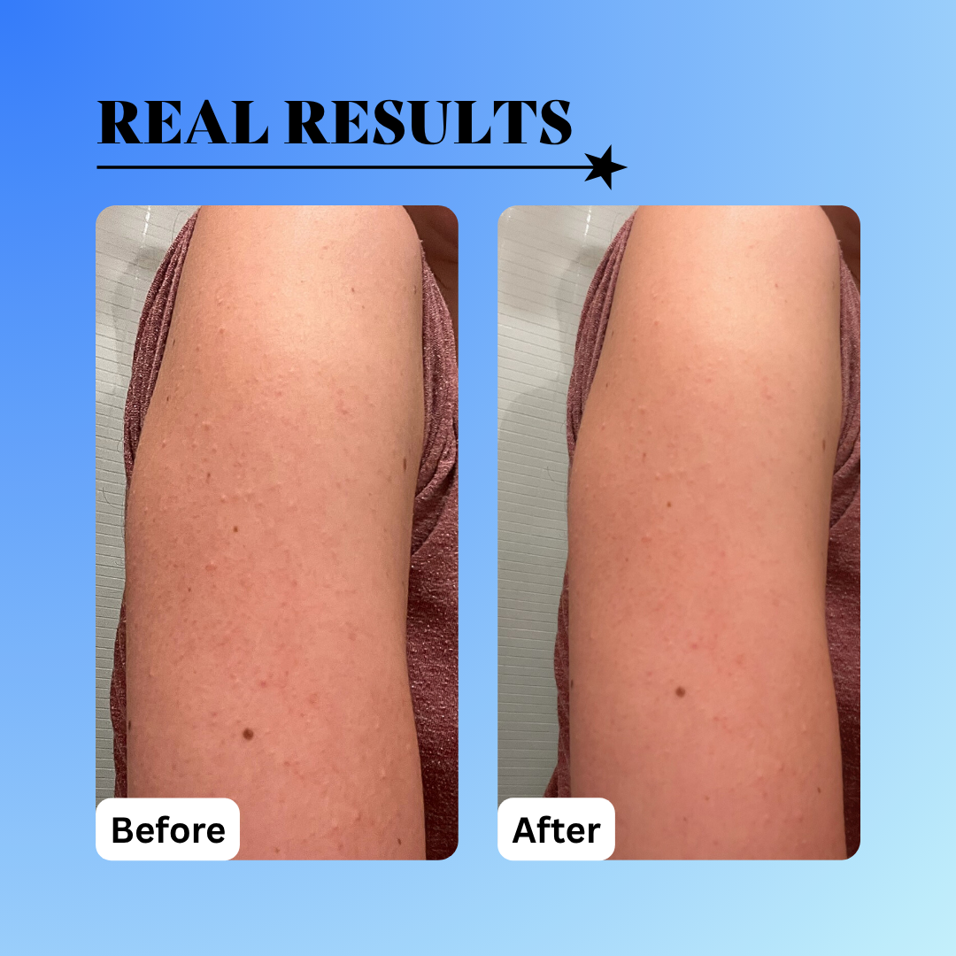 before and after keratosis pilaris using the 10% glycolic treatment tonic