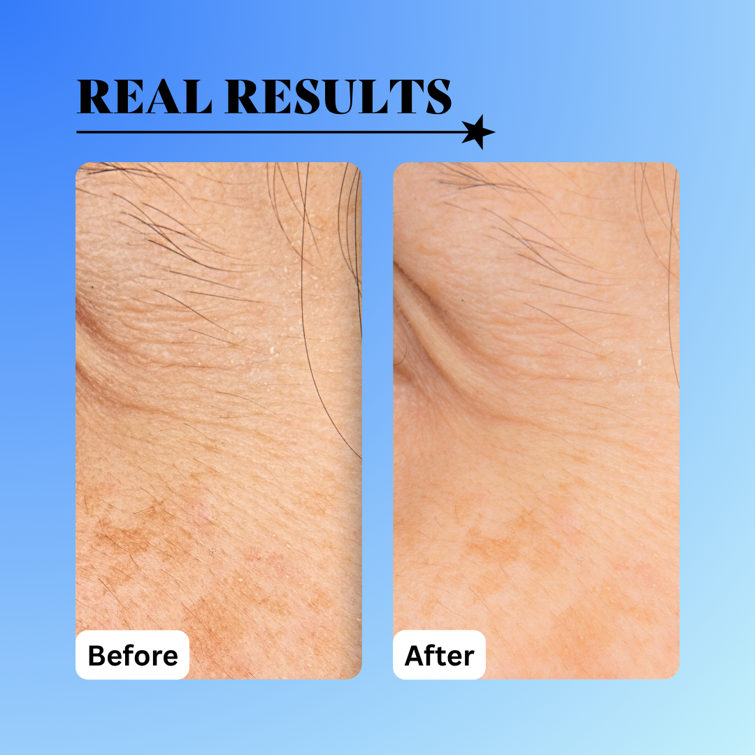 before and after discoloration using the 10% glycolic treatment tonic