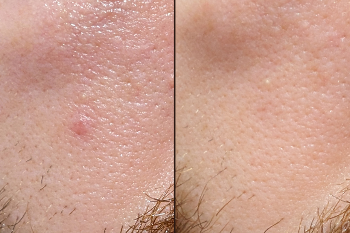 before and after of glycolic acid breakout