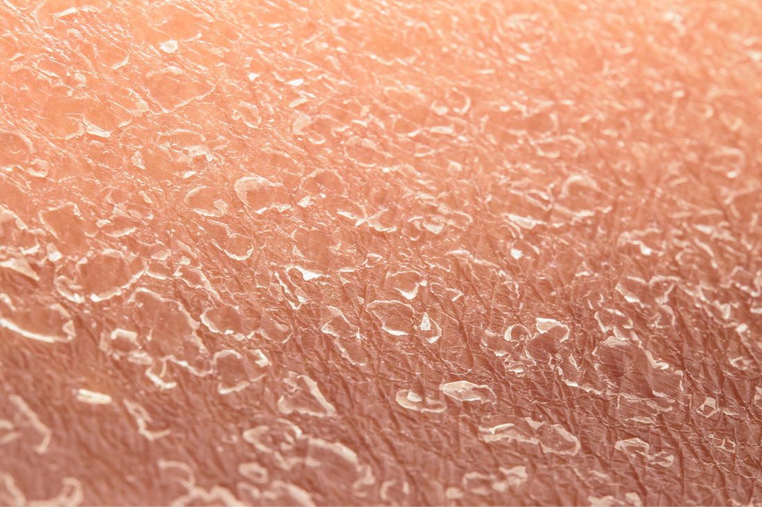 Tired of Tight & Flaky Skin? Discover the Ultimate Dry Skin Solutions