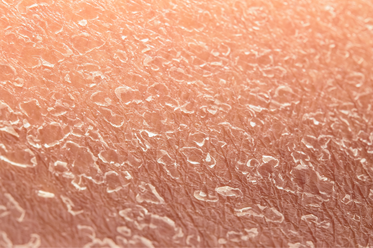 Close-up of dry, flaky skin texture