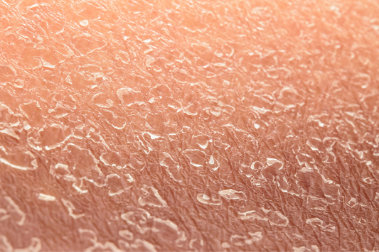 Tired of Tight & Flaky Skin? Discover the Ultimate Dry Skin Solutions