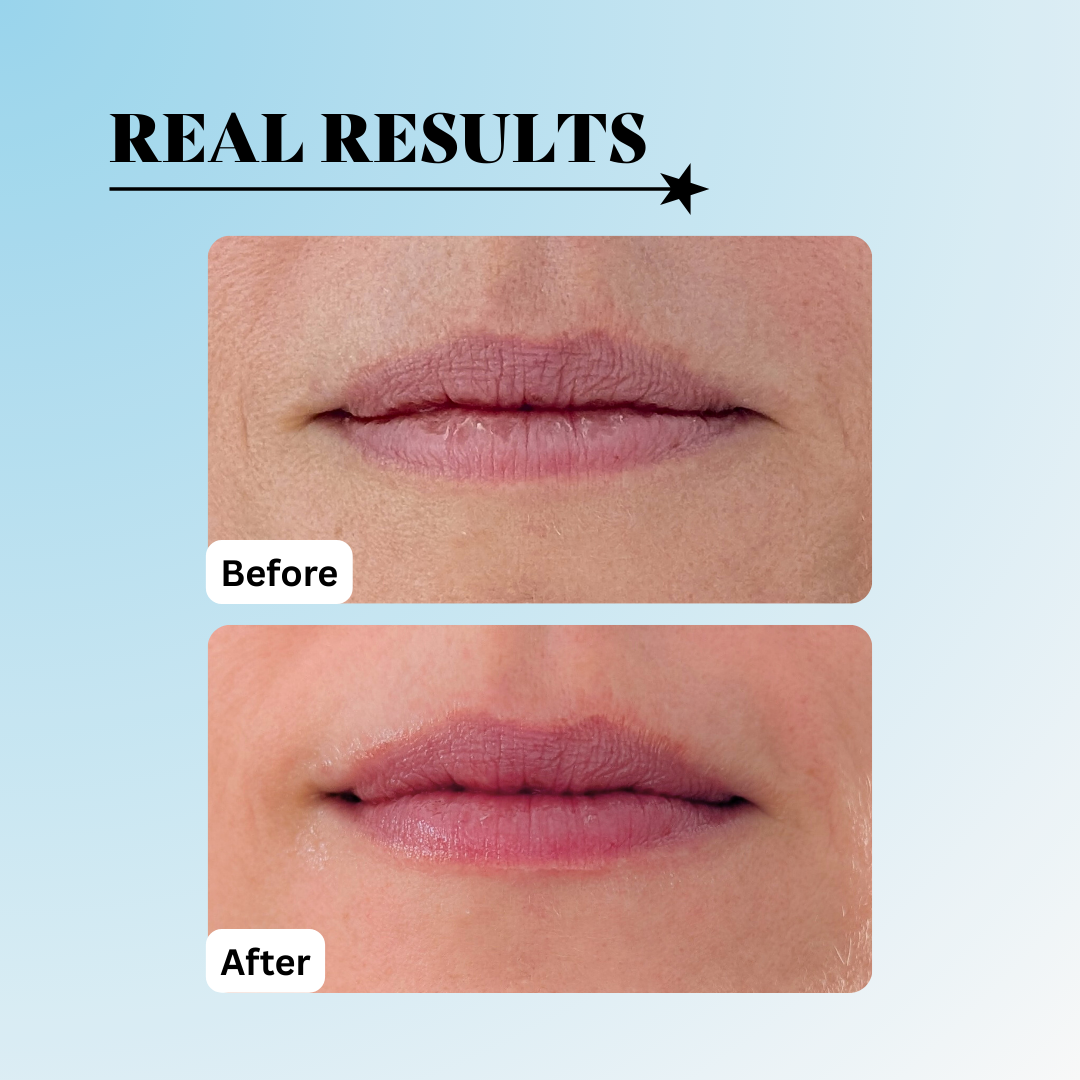 before and after dry lips