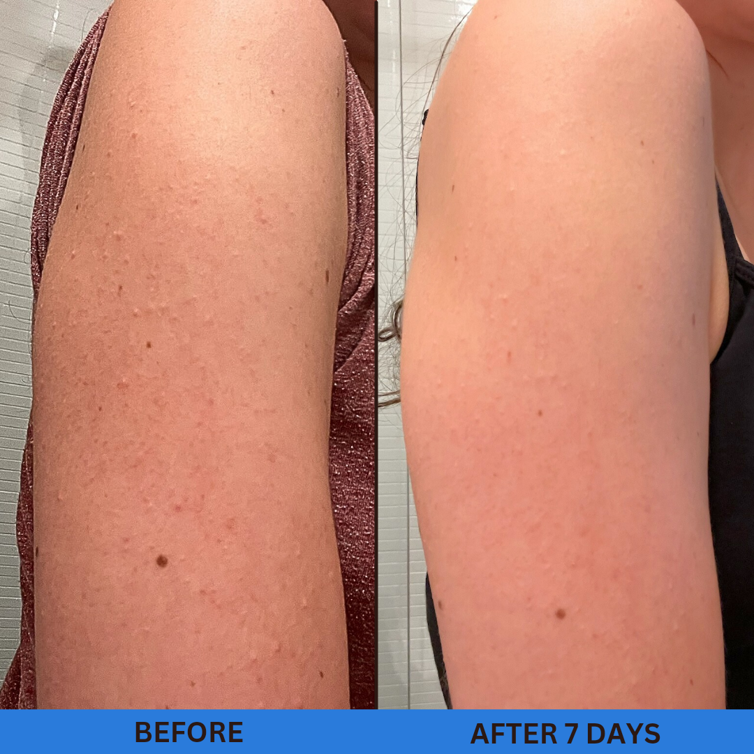 Keratosis Pilaris before and after