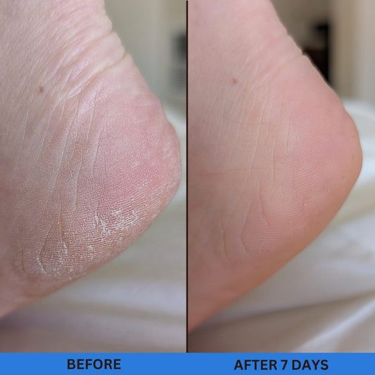 glycolic acid helps rough and dry skin on the feet and heels